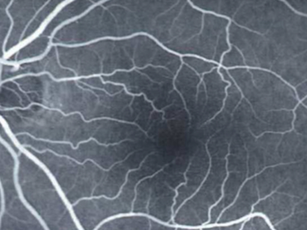 fluorangiografia della retina