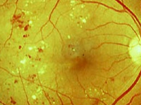 retinopatia diabetica non proliferativa grave